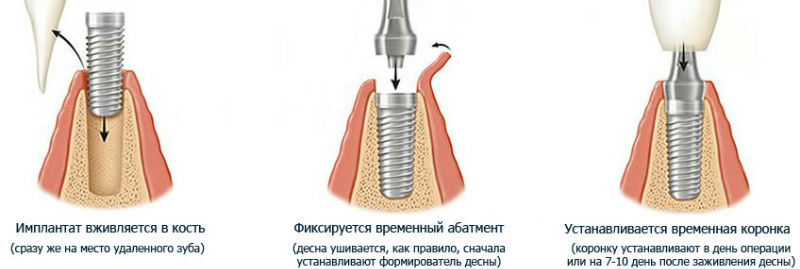 Одноэтапная имплантация зубов