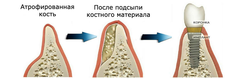Кісткова пластика (остеопластика)