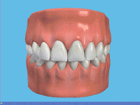 Незнімні зубні протези