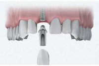 Двухэтапная имплантация зубов