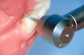 Лечение, препарирование одного зуба при всех видах кариеса (без наложения пломбы)