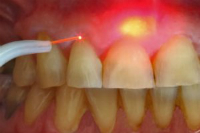 Лазер в стоматологической хирургии