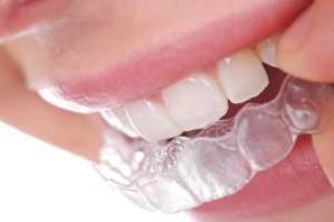 Флюоризация зубов
