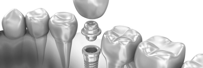 Двоетапна імплантація зубів