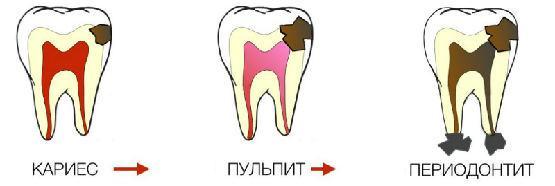 Лікування каналів зуба