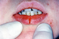 Лазерное лечение хронической трещины губы (один сеанс)