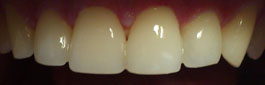 Прямая реставрация передних зубов с помощью компониров (одна единица)