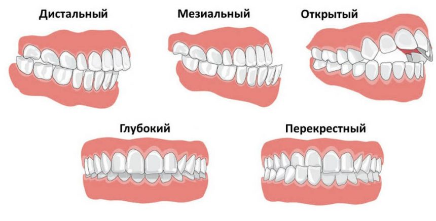 Исправление прикуса и выравнивание зубов, Харьков