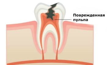 Если не лечить кариес - повреждення пульпа зуба