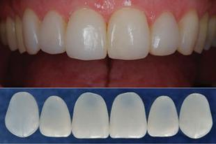 Прямая реставрация передних зубов с помощью компониров (одна единица)