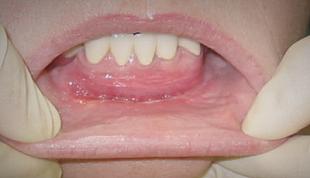Лазерная вестибулопластика - углубление преддверия полости рта (одна челюсть)