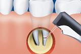 Операция цистэктомия с резекцией верхушки корня зуба (один зуб)