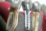 Установка титанового имплантата фирмы "Neodent", "Dentis Implant", "MEGA'GEN", "Bio3 Implants", "K3Pro konus dental implants" (одна единица)