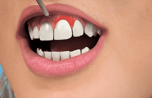 Лазерное удлинение коронки зуба (пластика десны)