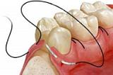 Пластическое закрытие дефекта в области одного зуба