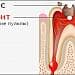 Лечение одного канала зуба при пульпите (без наложения пломбы)