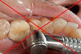 Микроинвазивное лечение начального кариеса беспрепаровочным способом (методом инфильтрации) с помощью препарата "Icon" (один зуб)