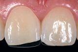 Художественная реставрация зуба (наращивание зуба) (одна единица)