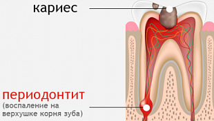 Лечение одного канала зуба при периодонтите (без наложения пломбы)