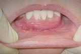 Лазерная вестибулопластика - углубление преддверия полости рта (одна челюсть)