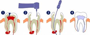 Лечение одного канала зуба при пульпите (без наложения пломбы)