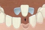 Восстановление отсутствующего зуба по адгезивной технологии