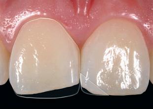 Художня реставрація зуба (нарощування зуба) (одна одиниця)