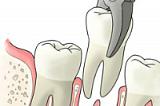 Удаление зуба сложное