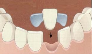 Восстановление отсутствующего зуба по адгезивной технологии