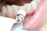 Зняття м'якого зубного нальоту (одна щелепа)