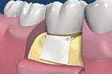 Лоскутная операция (один зуб)