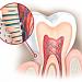 Снятие гиперестезии (чувствительности) зубов (один зуб)