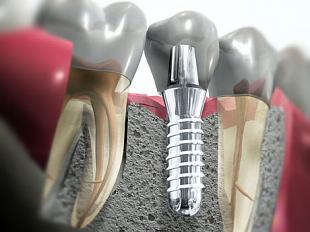 Установка титанового имплантата фирмы "A.B. dental devices", "Alpha Bio", "ITERUM-DENTAL IMPLANTS" (одна единица)